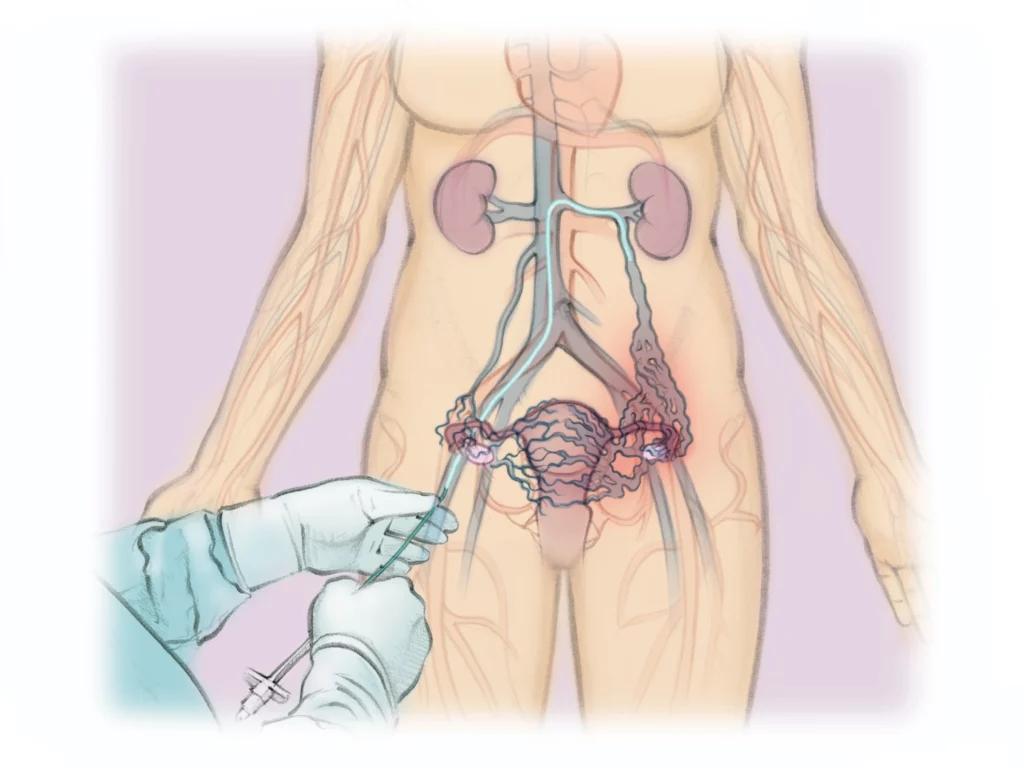 Diagram illustrating uterine fibroid embolization (UFE), a minimally invasive image-guided treatment offered by Peak IR Spokane to block blood flow to fibroids.