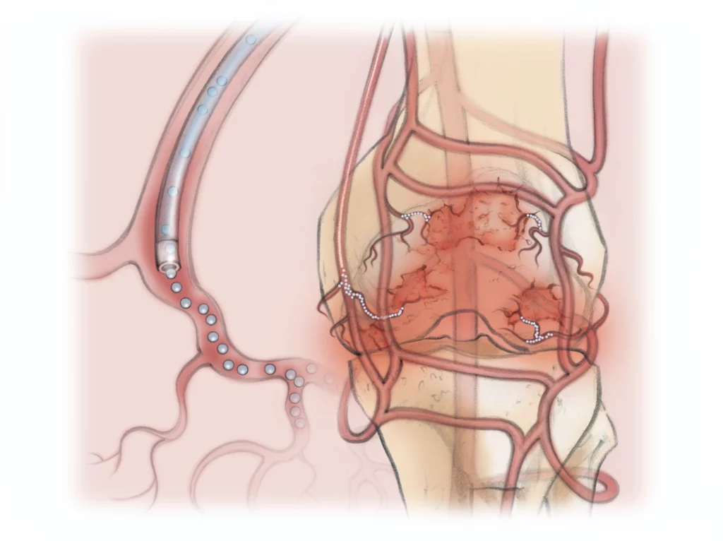 Medical illustration showing genicular artery embolization, a minimally invasive treatment used by Peak IR Spokane to reduce chronic knee pain caused by osteoarthritis.
