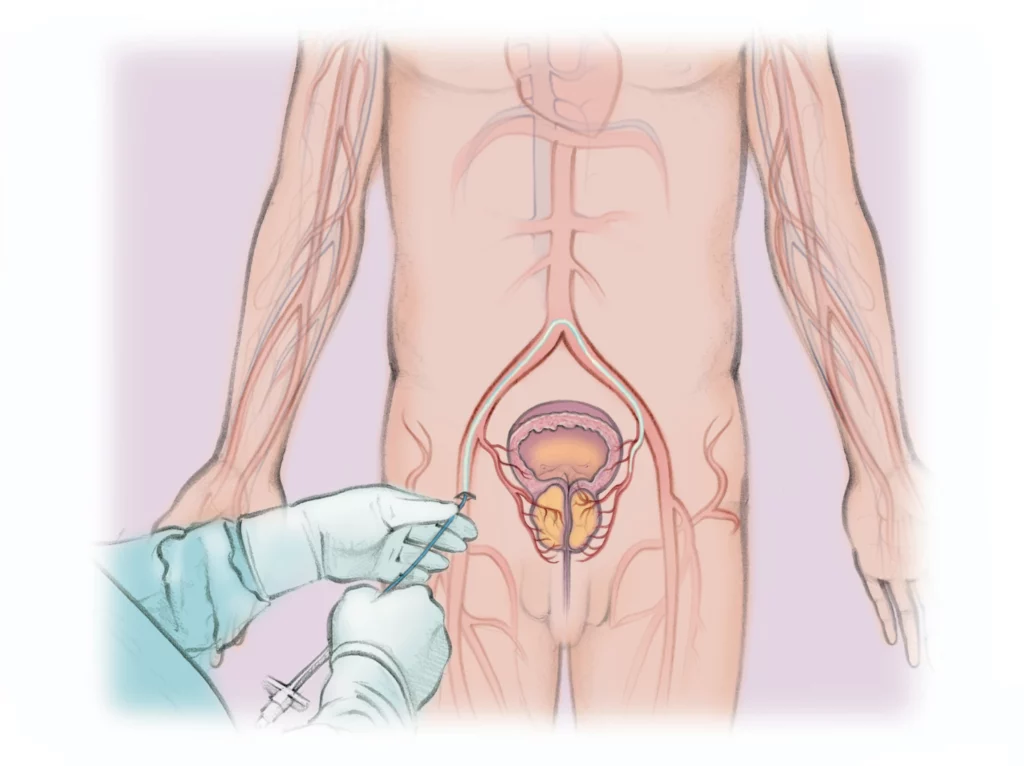 Medical illustration showing PAE treatment for BPH, a minimally invasive procedure used by Peak IR Spokane to reduce prostate size and improve urinary symptoms.