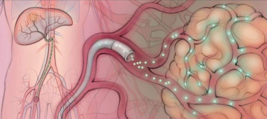 Illustration of TARE liver cancer treatment, an image-guided radioembolization procedure offered by Peak IR Spokane to target liver tumors.
