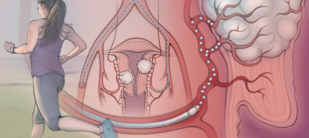 “Illustration of uterine fibroid embolization, a minimally invasive image-guided procedure offered by Peak IR Spokane to treat uterine fibroids and reduce symptoms.